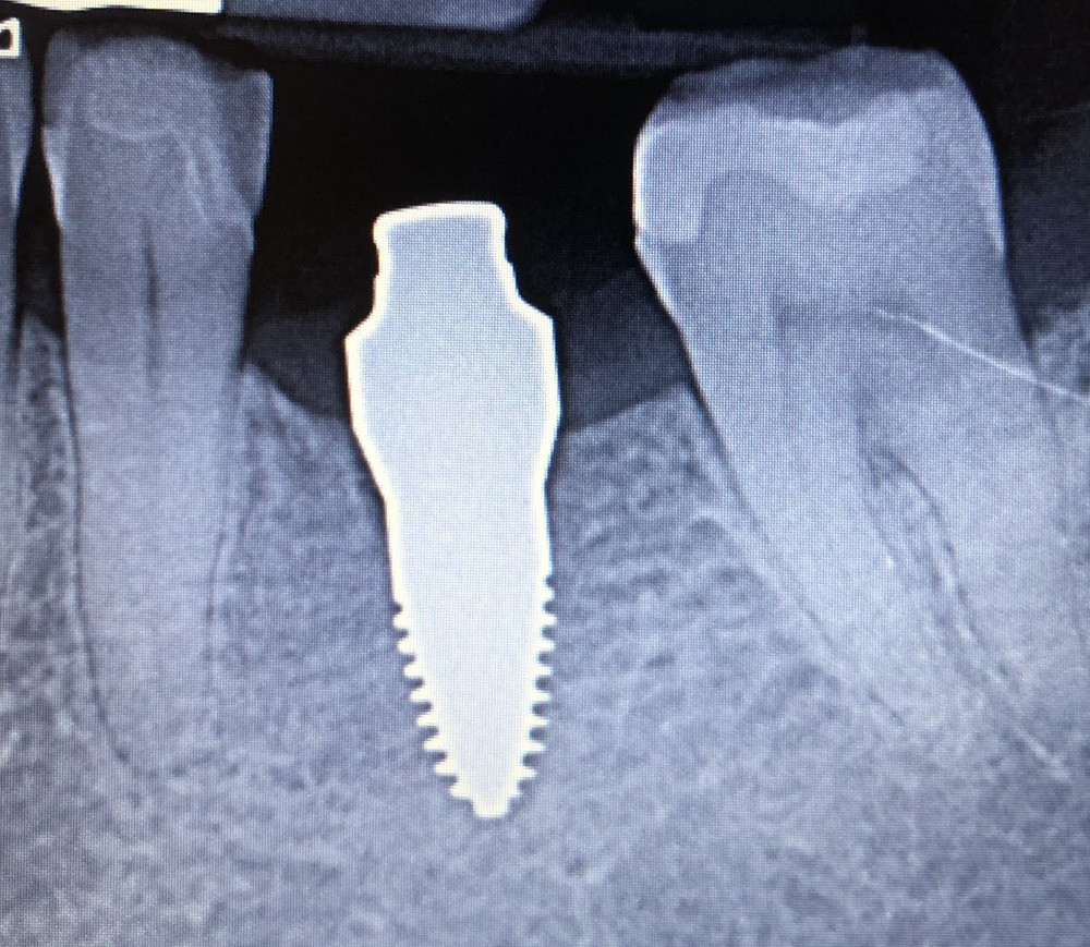Implantat